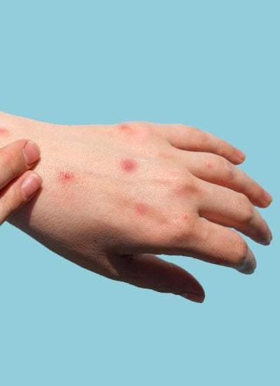 What parents should know about Monkeypox