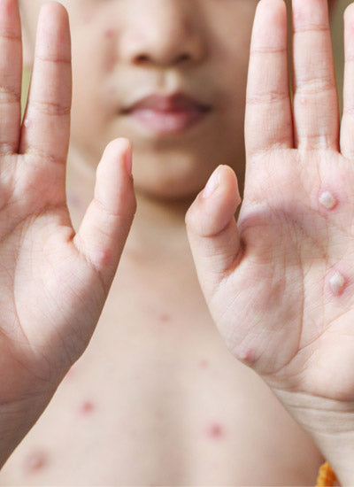 How you can fight the tomato flu